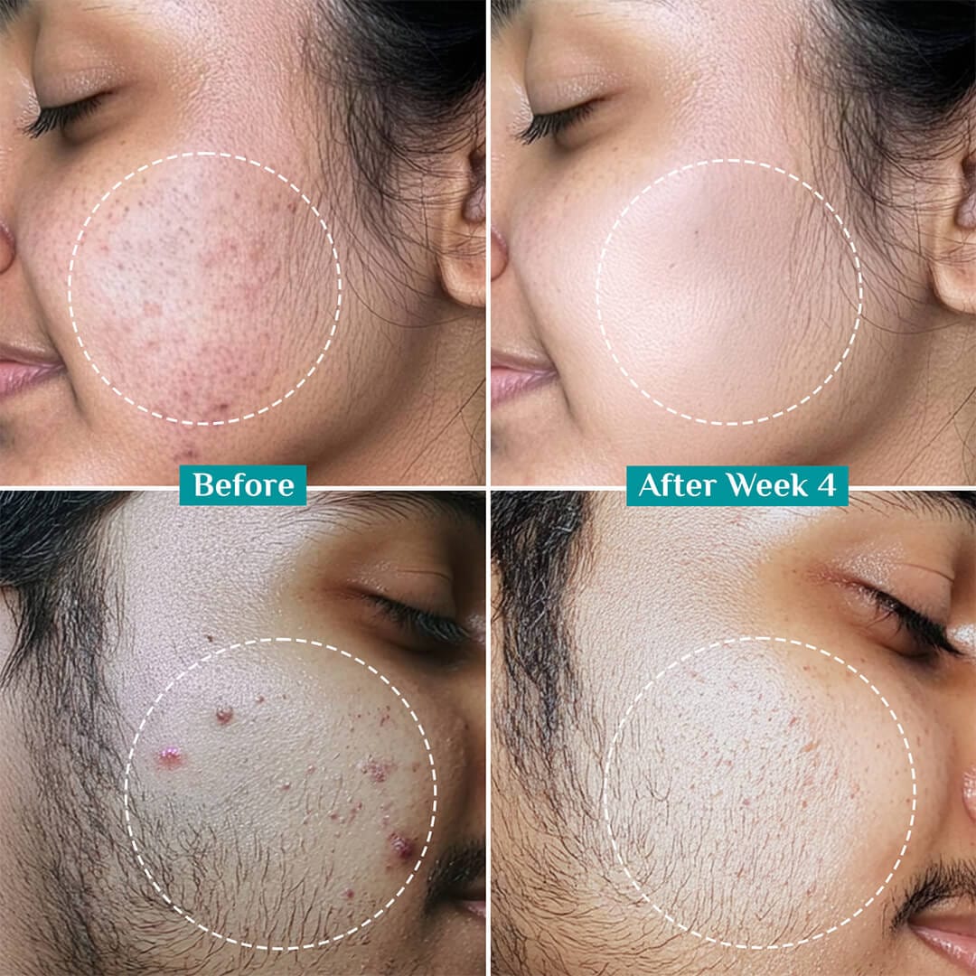 2% Salicylic Acid Anti-Acne Face Serum