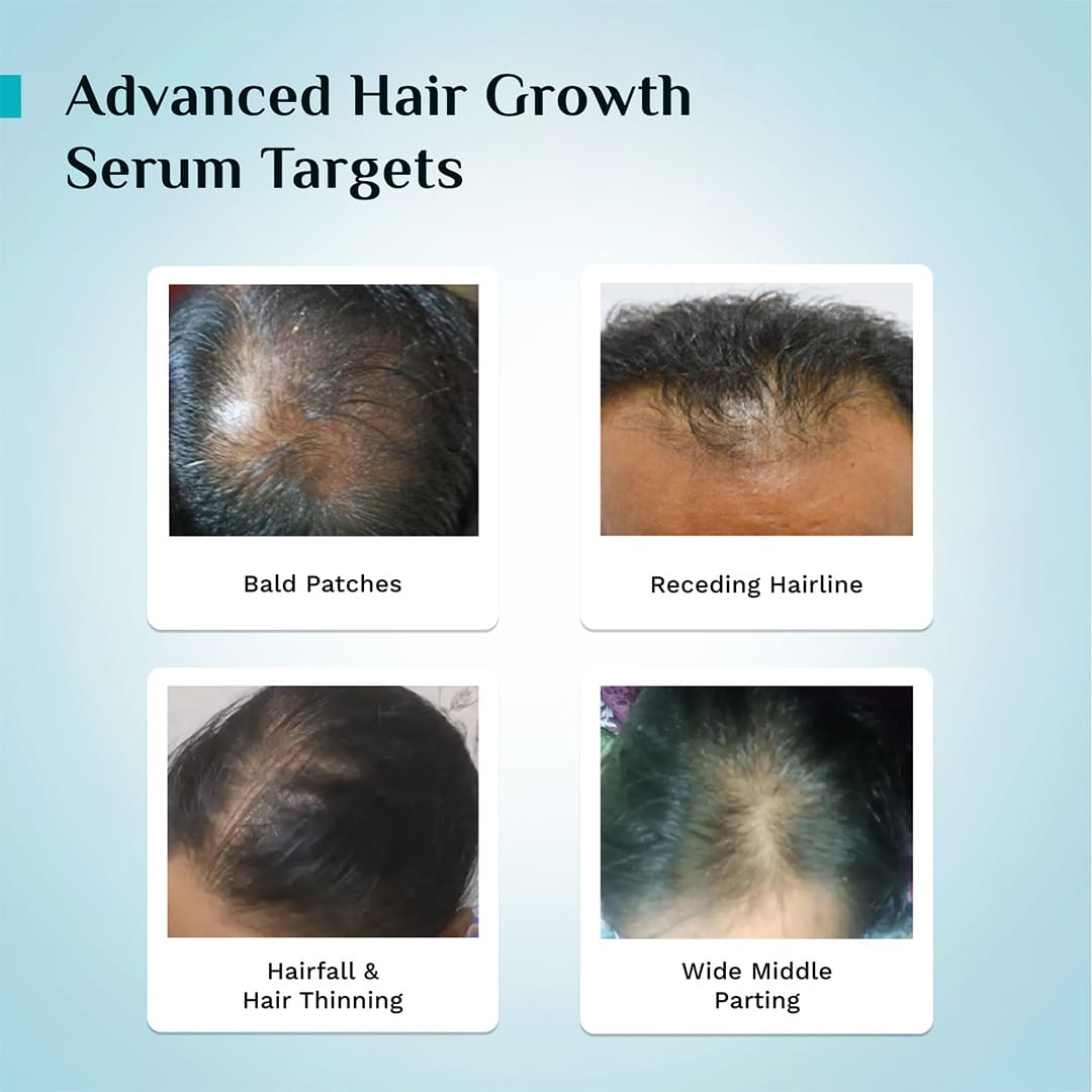 3% Redensyl, 4% Anagain & 5% Capilia Stem Cell Complex Advanced Hair Growth Serum