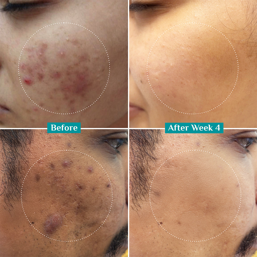 10% Niacinamide Face Serum With 1% Zinc PCA