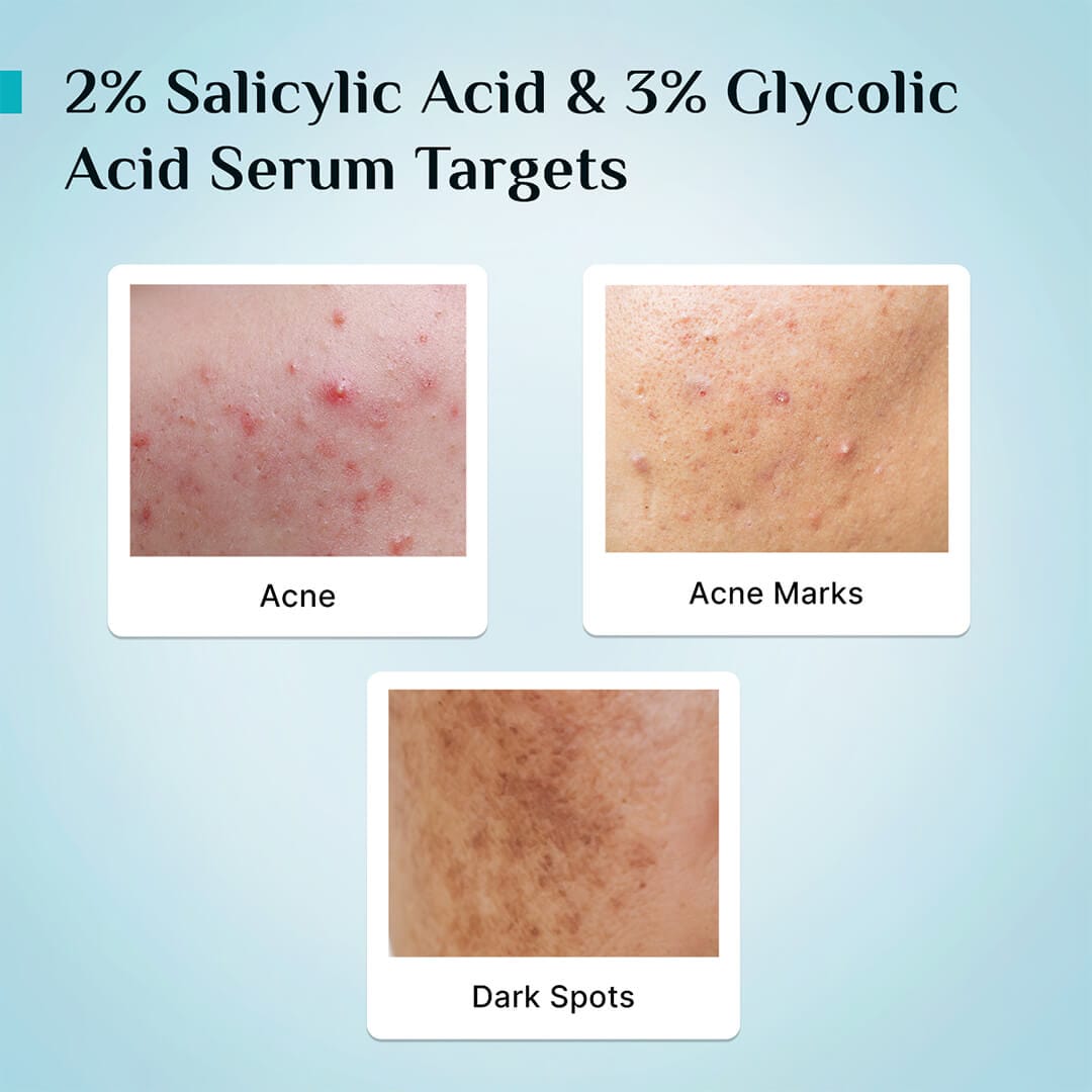 2% Salicylic Acid Anti-Acne Face Serum