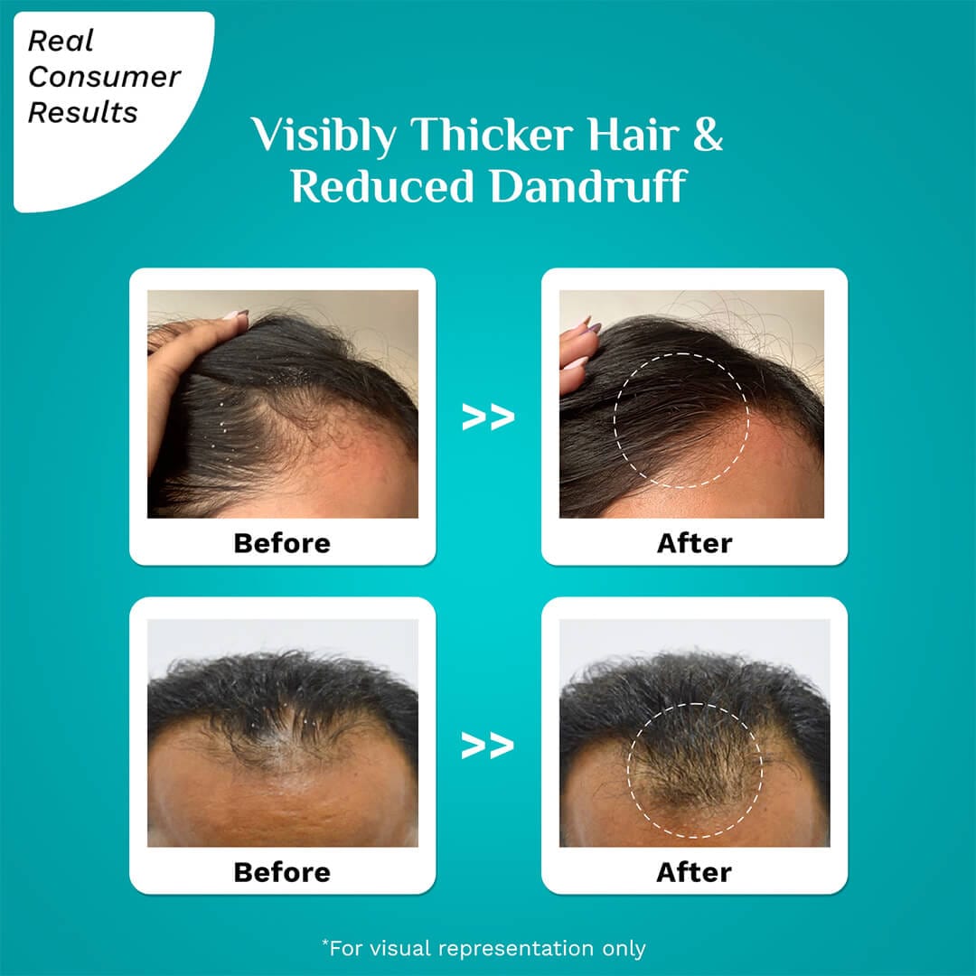 3% Redensyl & 4% Anagain Advanced Hair Growth Serum For Dandruff-Prone Scalp - 30 ml