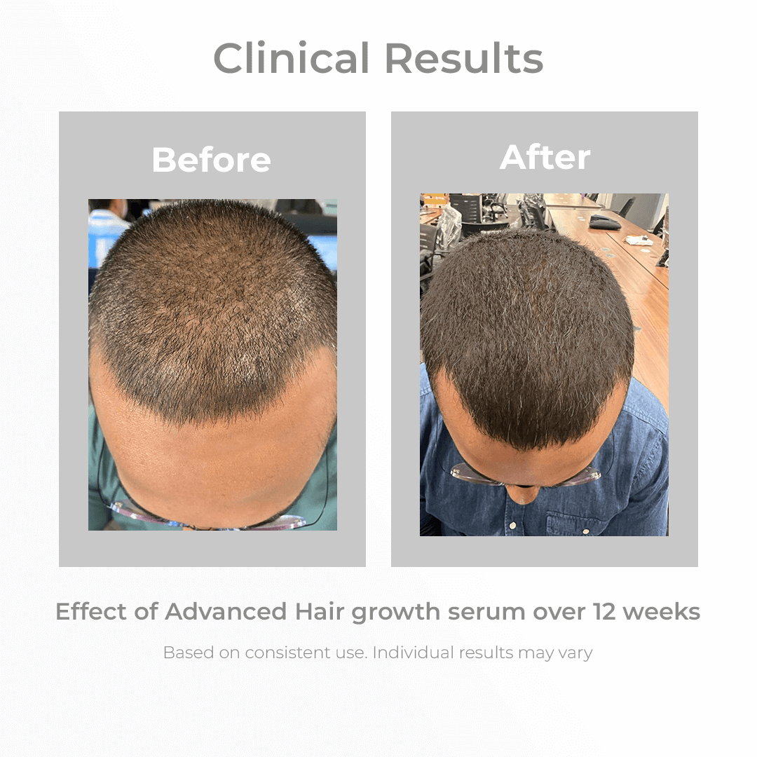 3% Redensyl + 4% Anagain Hair Growth Serum (Natural DHT Blocker)