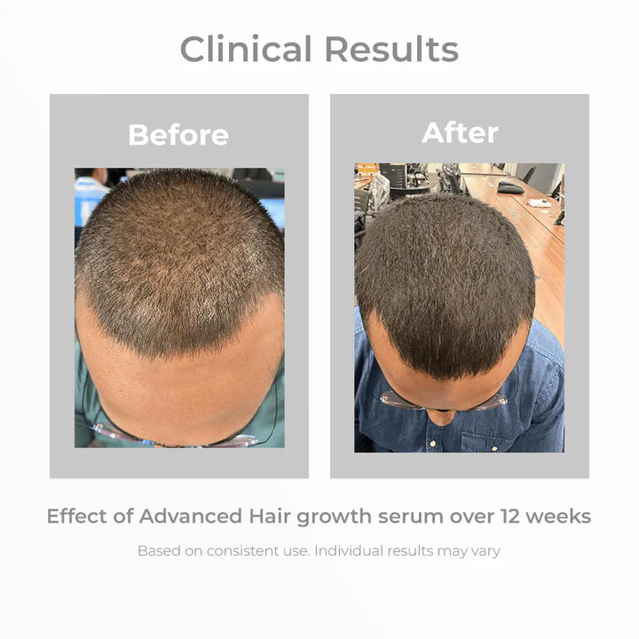 3% Redensyl + 4% Anagain Hair Growth Serum for Men