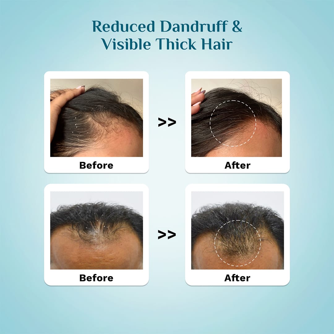 3% Redensyl & 4% Anagain Advanced Hair Growth Serum For Dandruff-Prone Scalp - 30 ml