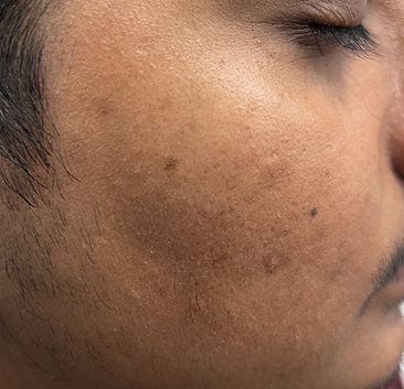 Before using 10% Vitamin C Face Serum For Triple Glow+++
