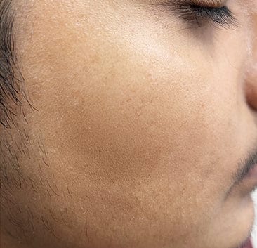 After using 10% Vitamin C Face Serum For Triple Glow+++