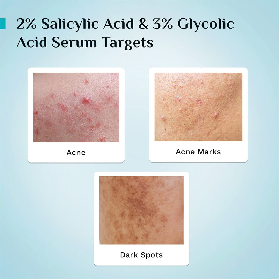 2% Salicylic Acid Anti-Acne Face Serum