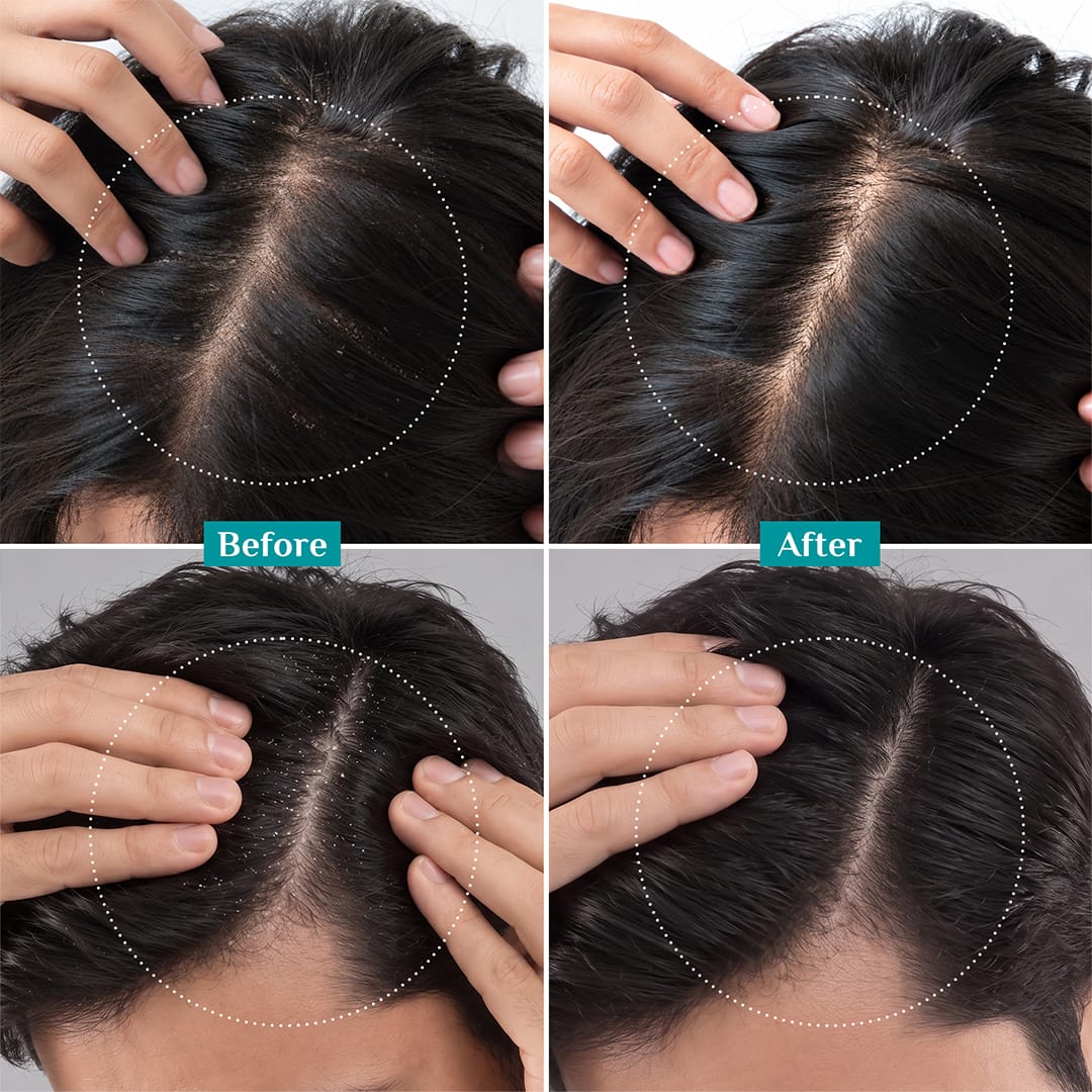 Australian Tea Tree  Anti-Dandruff Scalp Serum