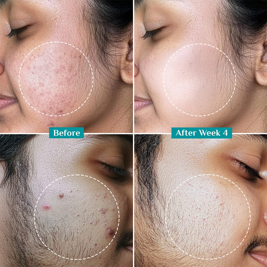 2% Salicylic Acid Anti-Acne Face Serum