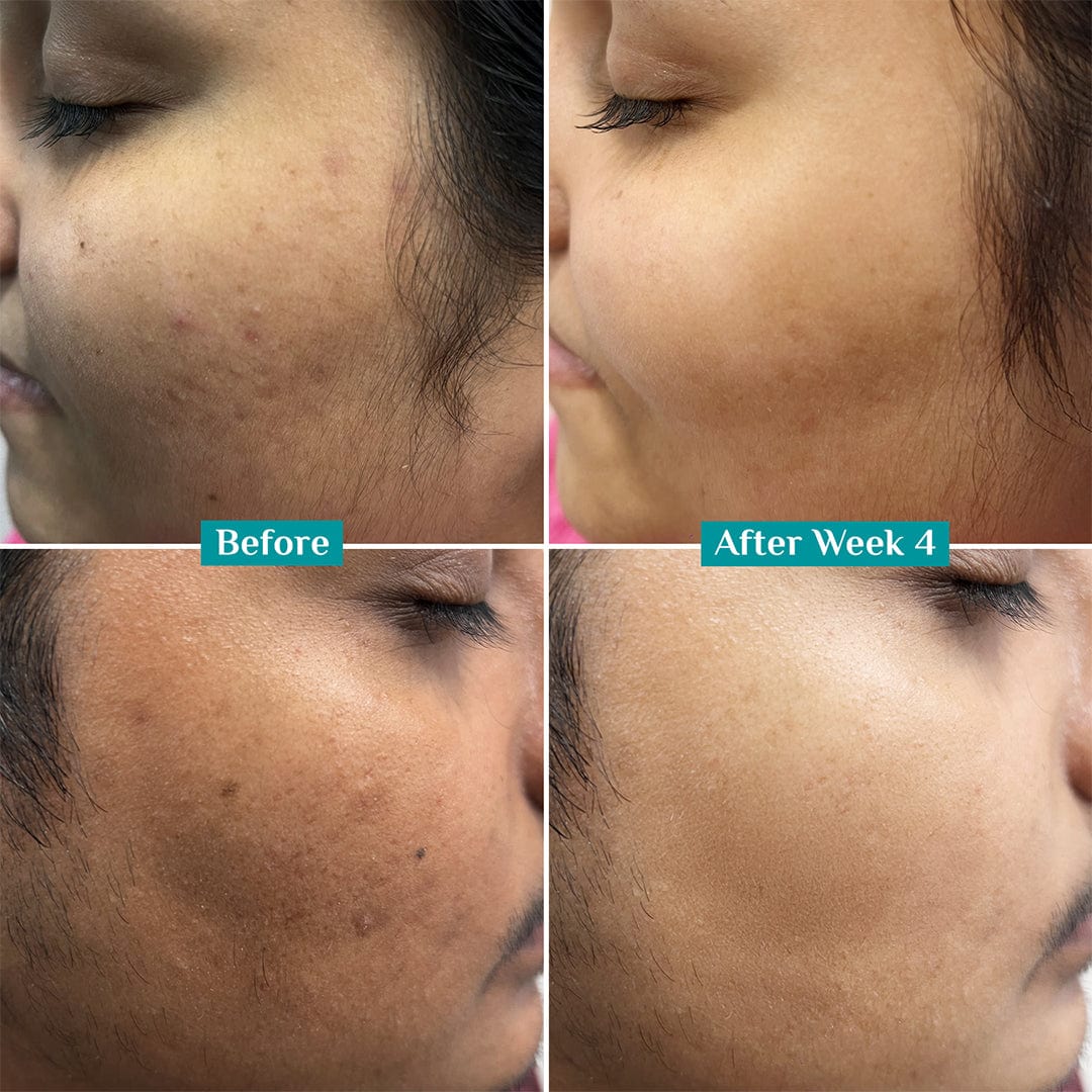 Does Vitamin C Help With Acne Scars? Proven Healing Secrets