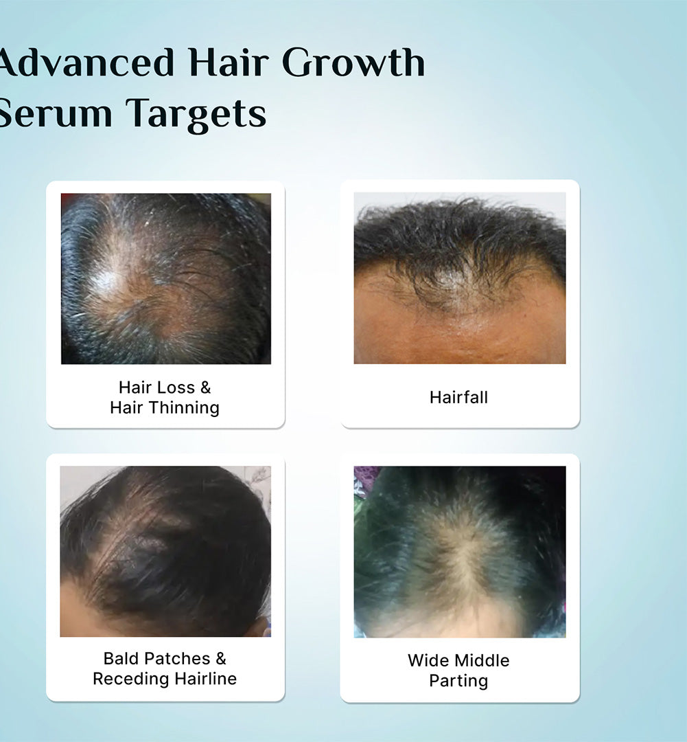 3% Redensyl + 4% Anagain Hair Growth Serum