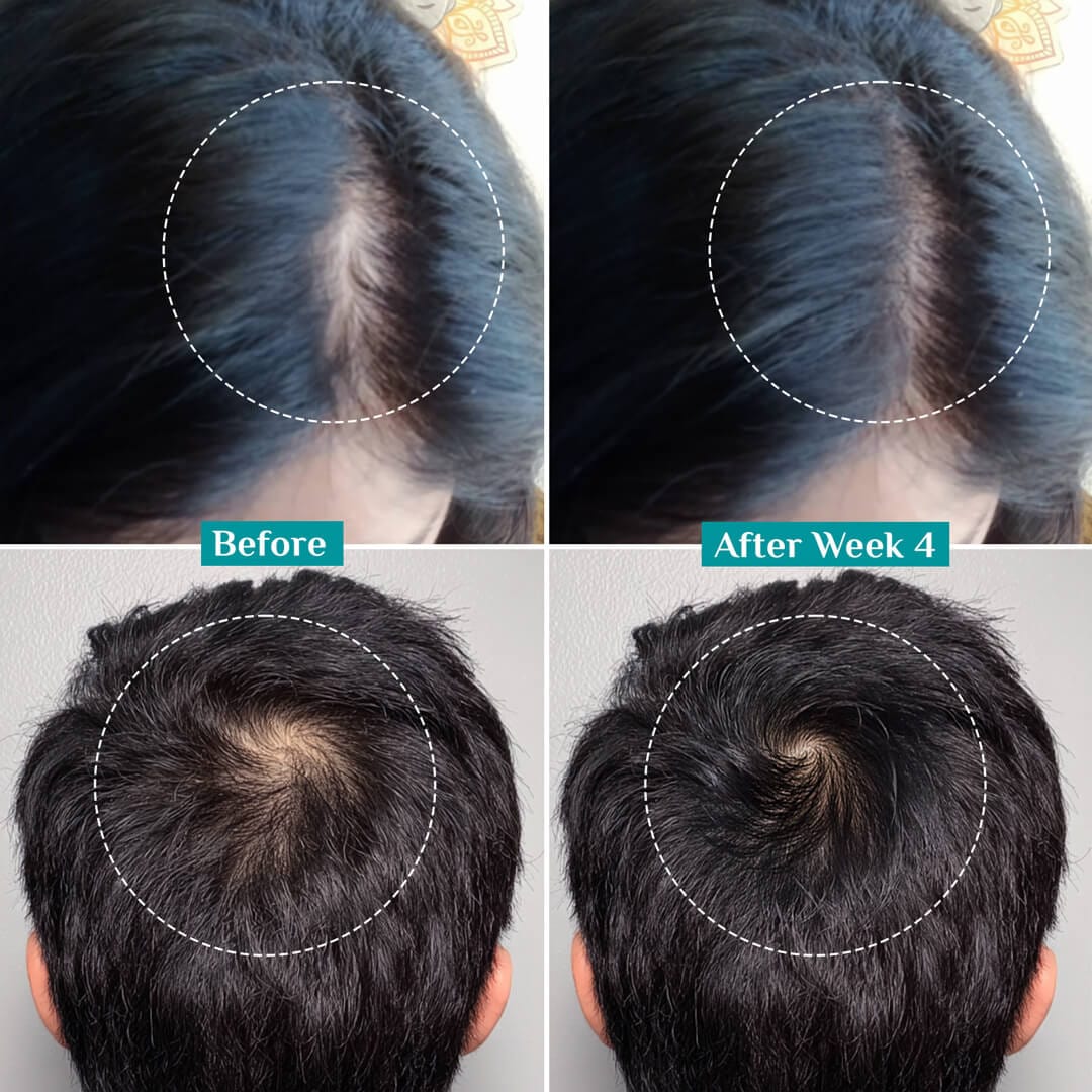 3% Redensyl + 4% Anagain Hair Growth Serum