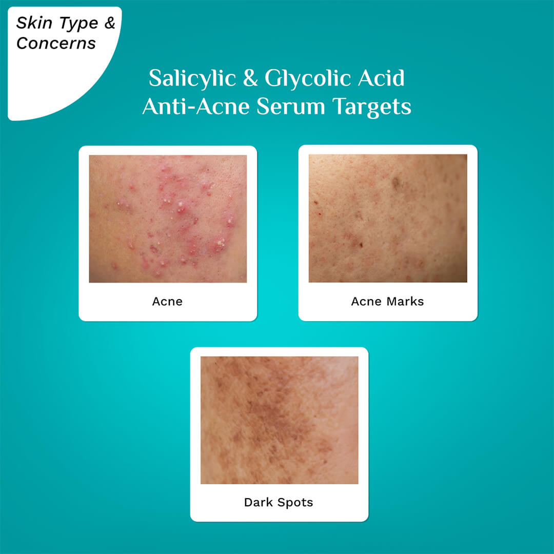 2% Salicylic Acid Anti-Acne Face Serum